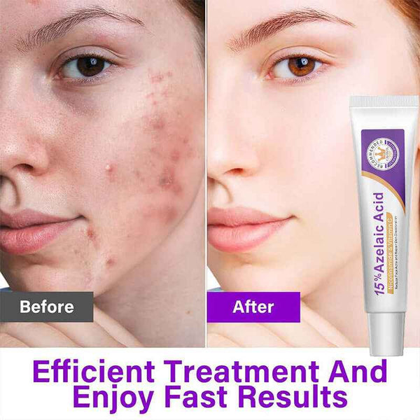 Revitalize Your Skin with Our Azelaic Acid Skin Brightener - Enhanced with Niacinamide & Vitamin C